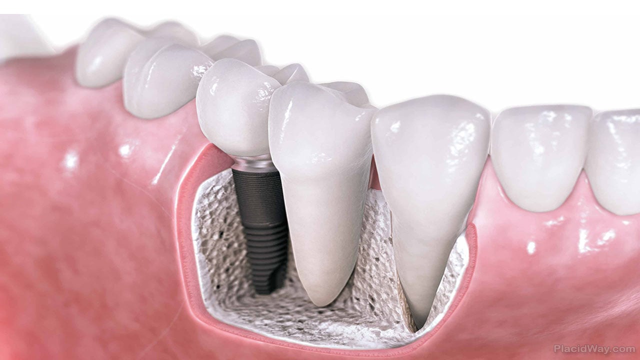 Dental implant