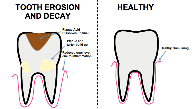 Tooth Decay