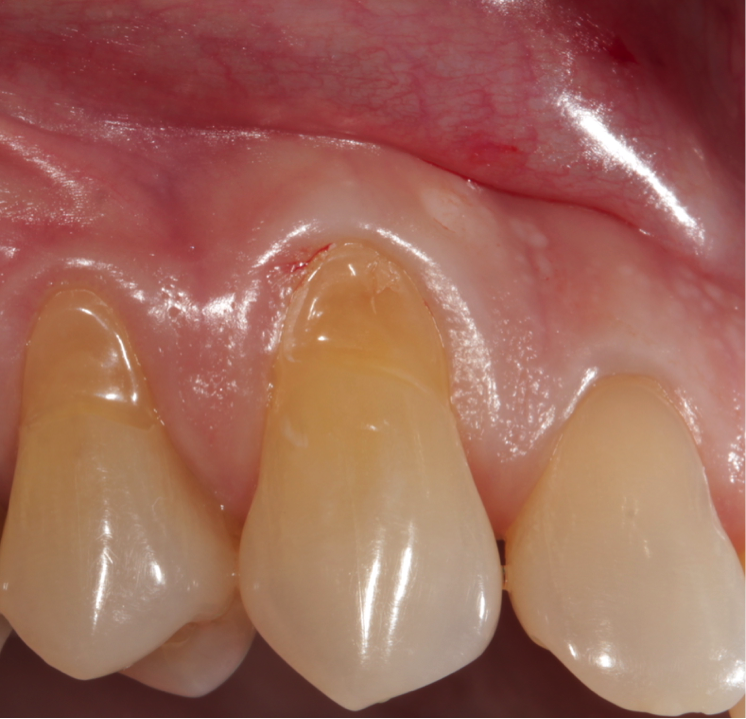 gum graft