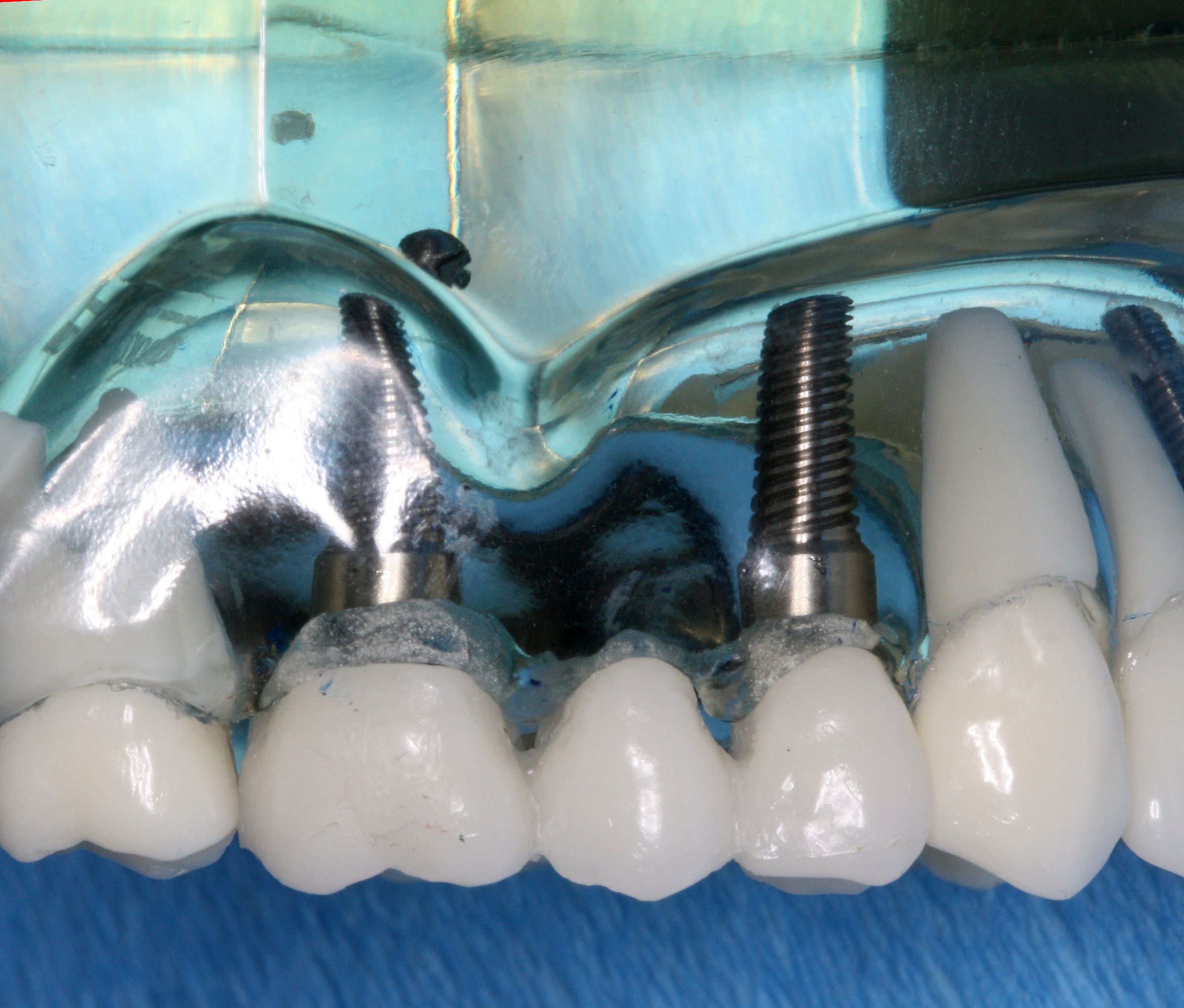 A dental implant supported bridge is the most stable