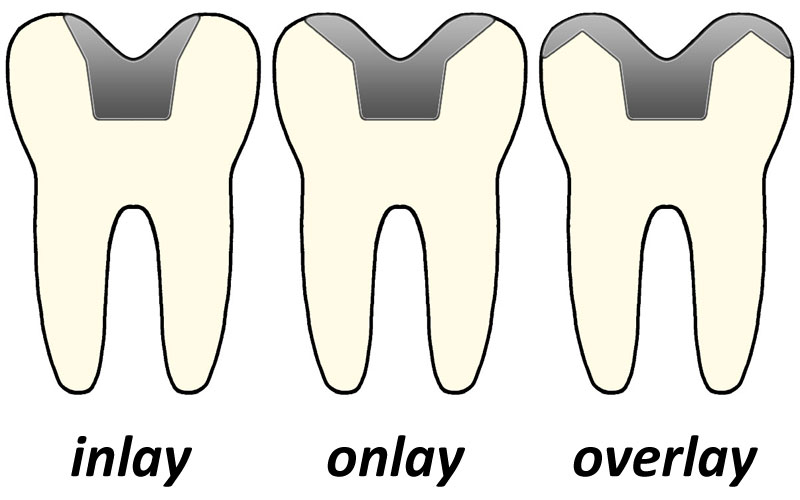 inlay onlay