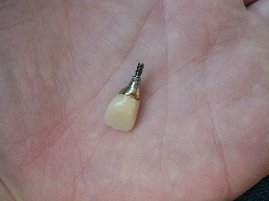  price of dental implants