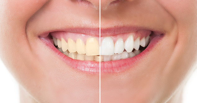 How effective is the tooth whitening sticker? 