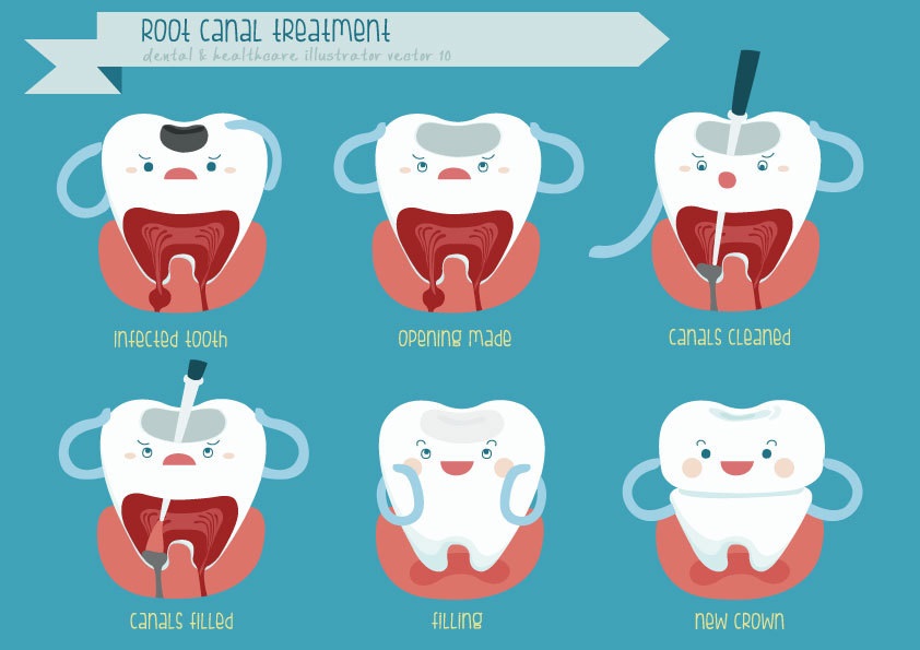 Root canal treatment