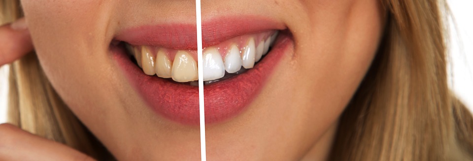 tooth whitening