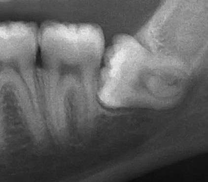 Impacted wisdom tooth